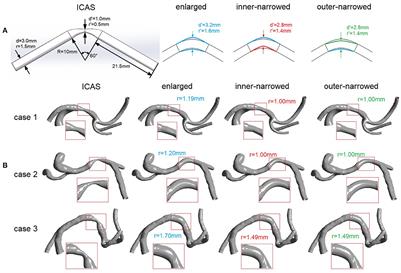 Effects of stent shape on focal hemodynamics in intracranial atherosclerotic stenosis: A simulation study with computational fluid dynamics modeling